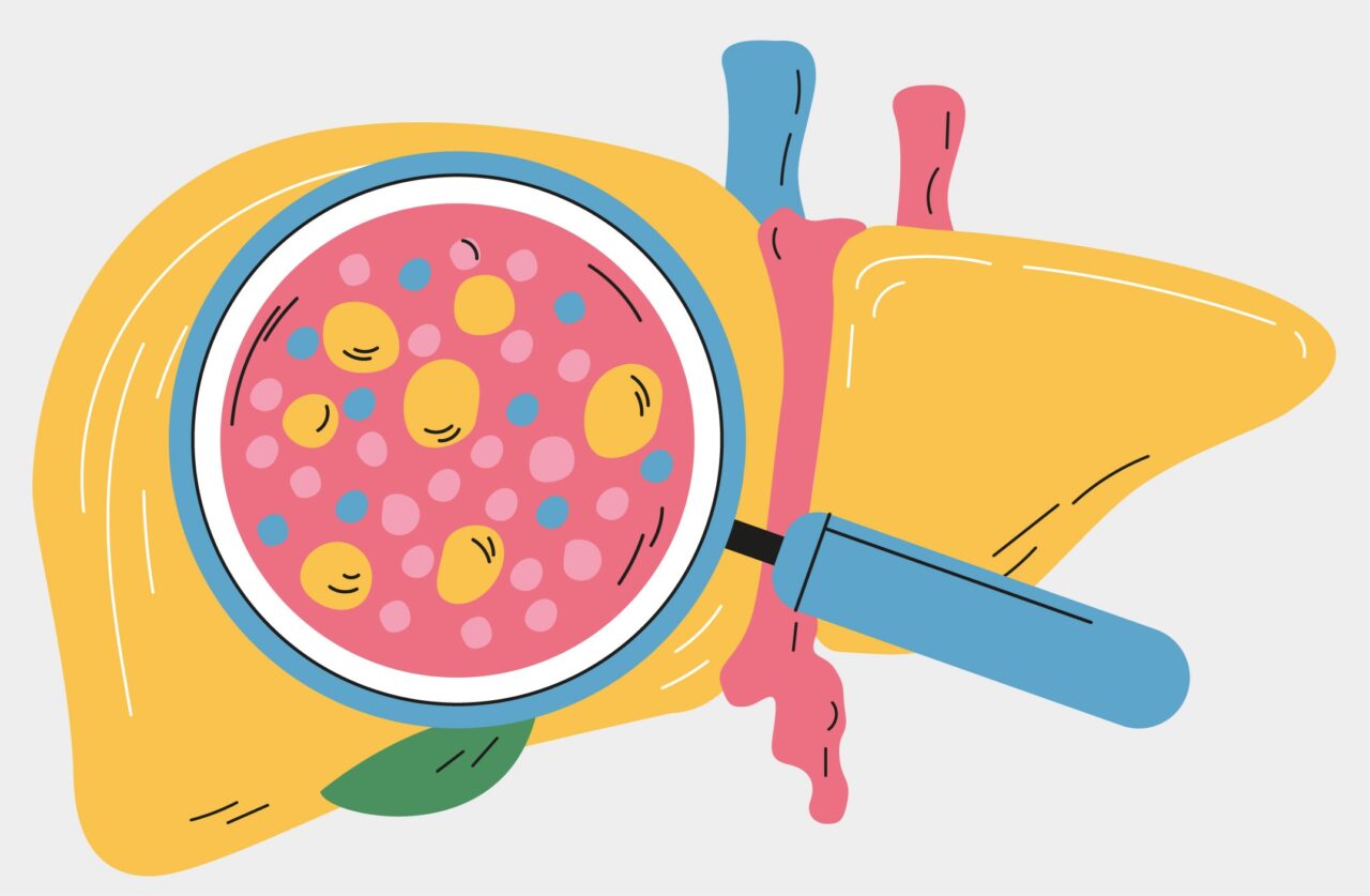 Actualización en las guías clínicas para el manejo de la MASLD