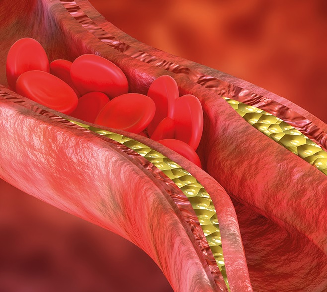 Desafíos del control lipídico en diabetes