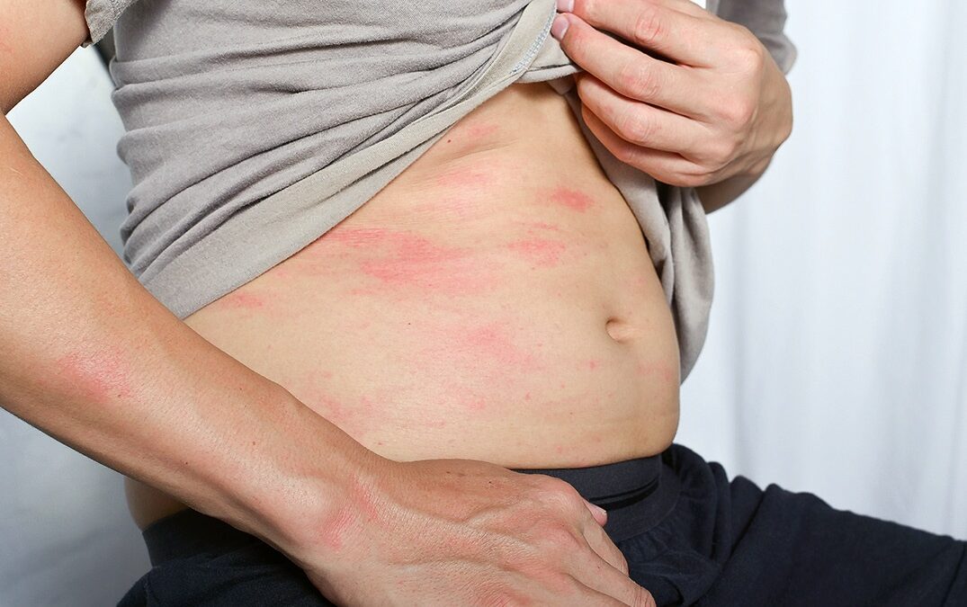 Lipohipertrofias parte II. Prevalencia y frecuencia de lipohipertrofias y otras lesiones de la piel en personas que se administran insulina