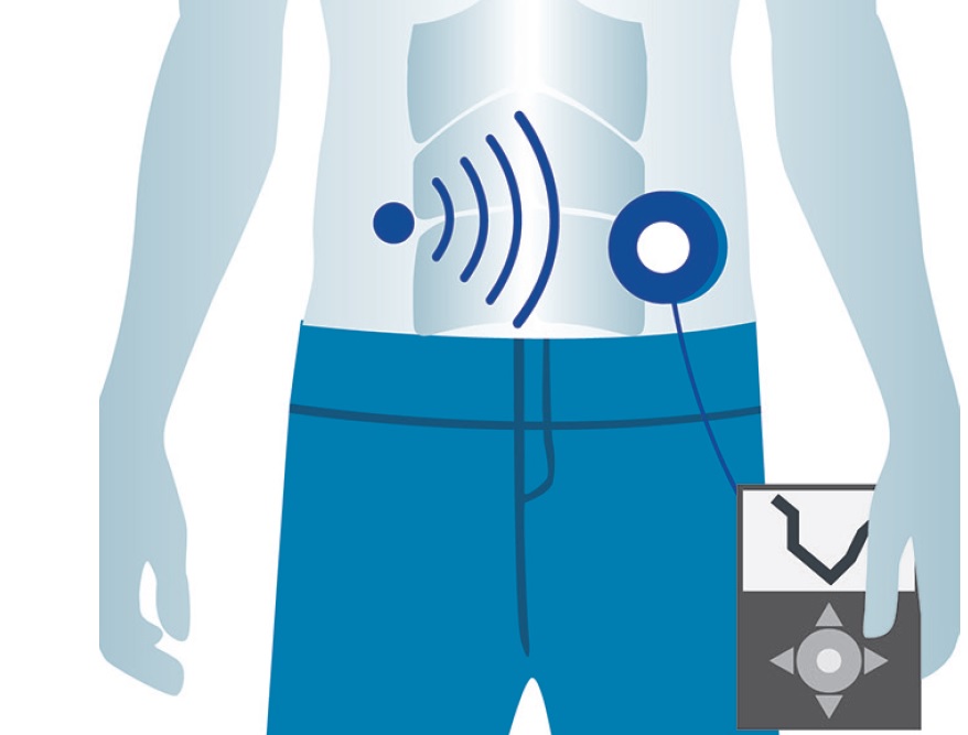 Sistemas de asa cerrada (páncreas artificial) sin anuncio de ingesta ni ejercicio en diabetes.  ¿Están próximos?